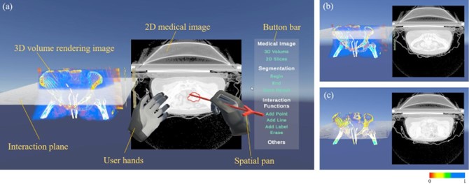 20230521-乐竞首页医学院博士生张楠、杨讷与李阳曦在中国生物医学工程大会暨创新医疗峰会上获奖-张楠-基于三维空间交互的宫颈癌靶区勾画虚拟现实环境总览.jpg